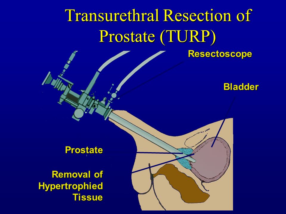 Was ist eine transurethrale resektion der prostats